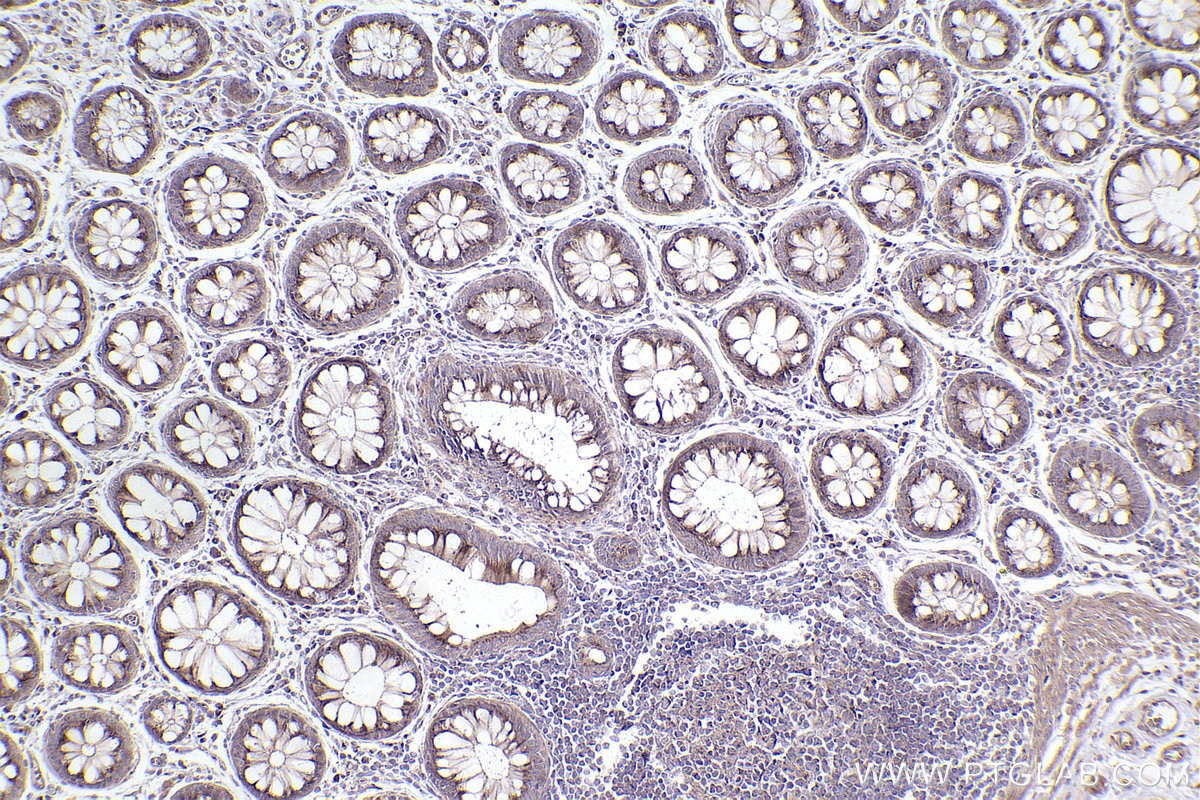 Immunohistochemistry (IHC) staining of human rectal cancer tissue using Giantin Polyclonal antibody (22270-1-AP)