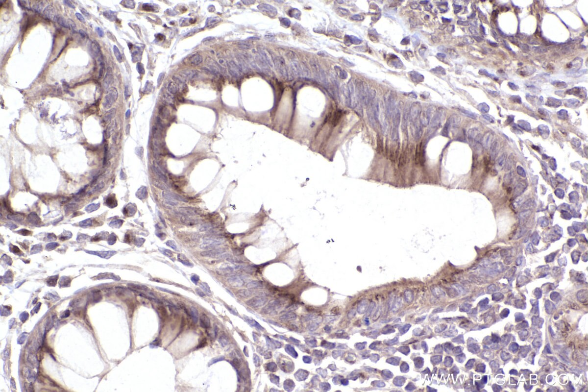 Immunohistochemistry (IHC) staining of human rectal cancer tissue using Giantin Polyclonal antibody (22270-1-AP)