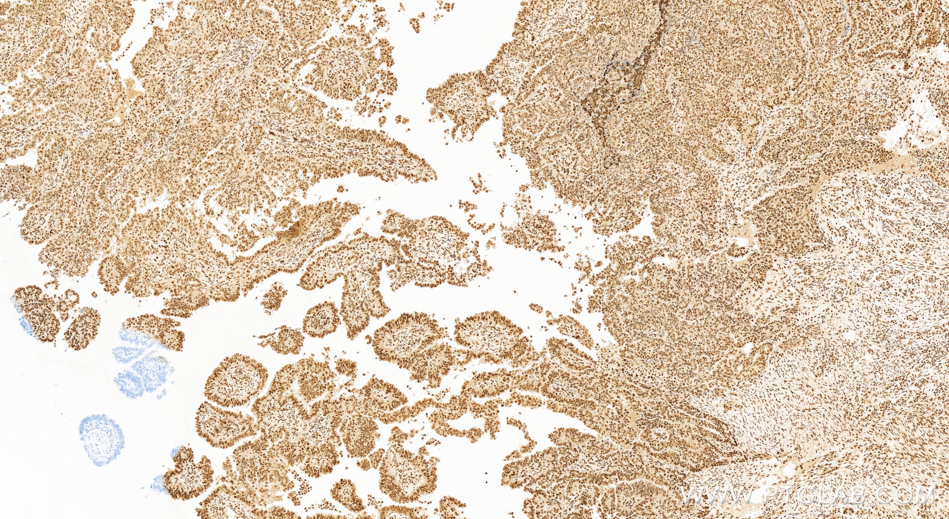 Immunohistochemistry (IHC) staining of human ovary cancer tissue using Glucocorticoid receptor Recombinant antibody (82619-4-RR)