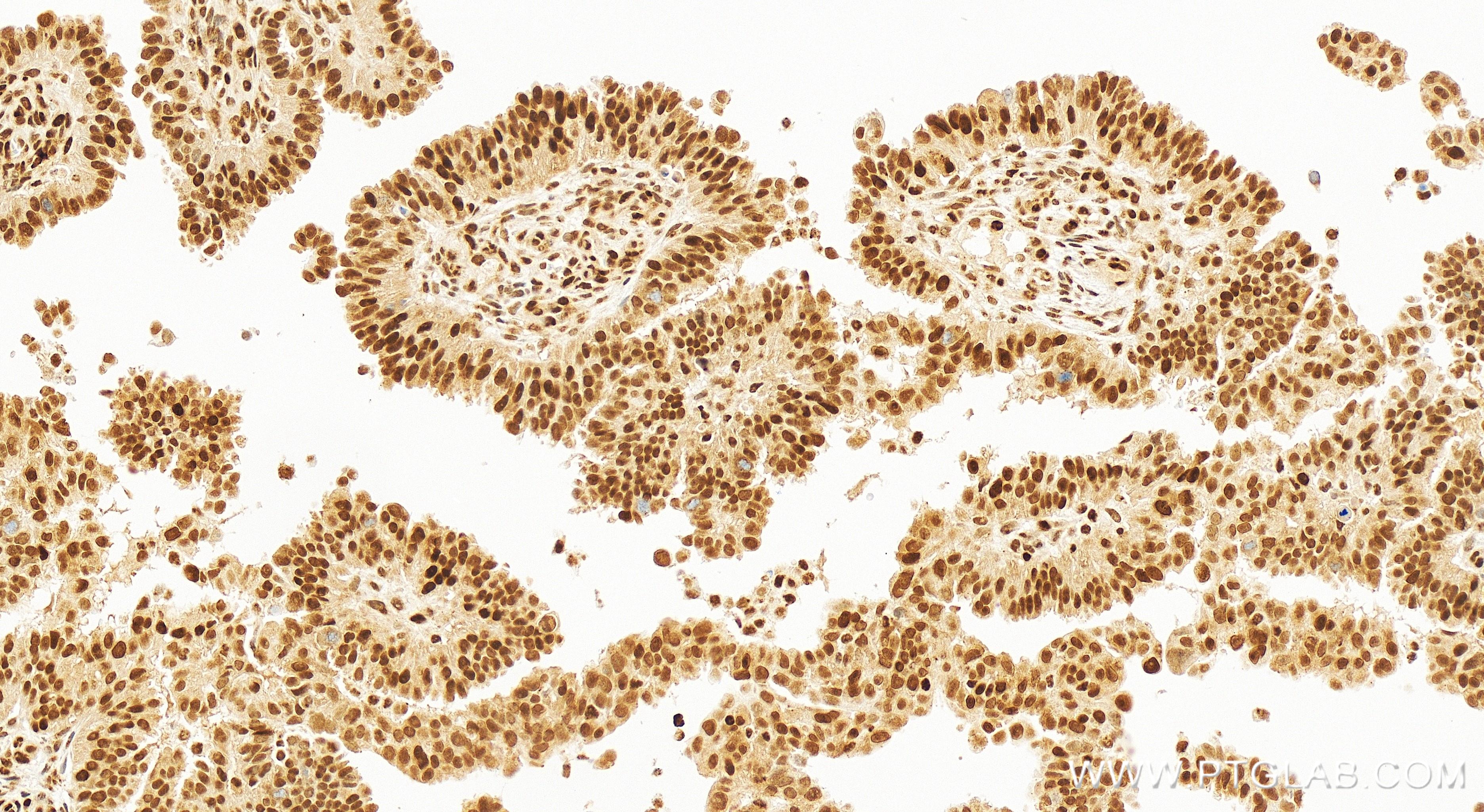 Immunohistochemistry (IHC) staining of human ovary cancer tissue using Glucocorticoid receptor Recombinant antibody (82619-4-RR)