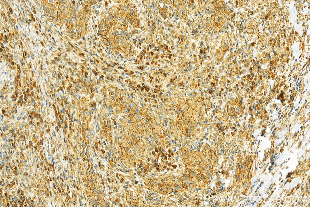 Immunohistochemistry (IHC) staining of human skin cancer tissue using GlyT2 Polyclonal antibody (25948-1-AP)