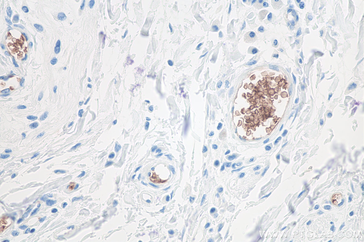Immunohistochemistry (IHC) staining of human colon cancer tissue using Glycophorin A/CD235a Monoclonal antibody (66778-1-Ig)