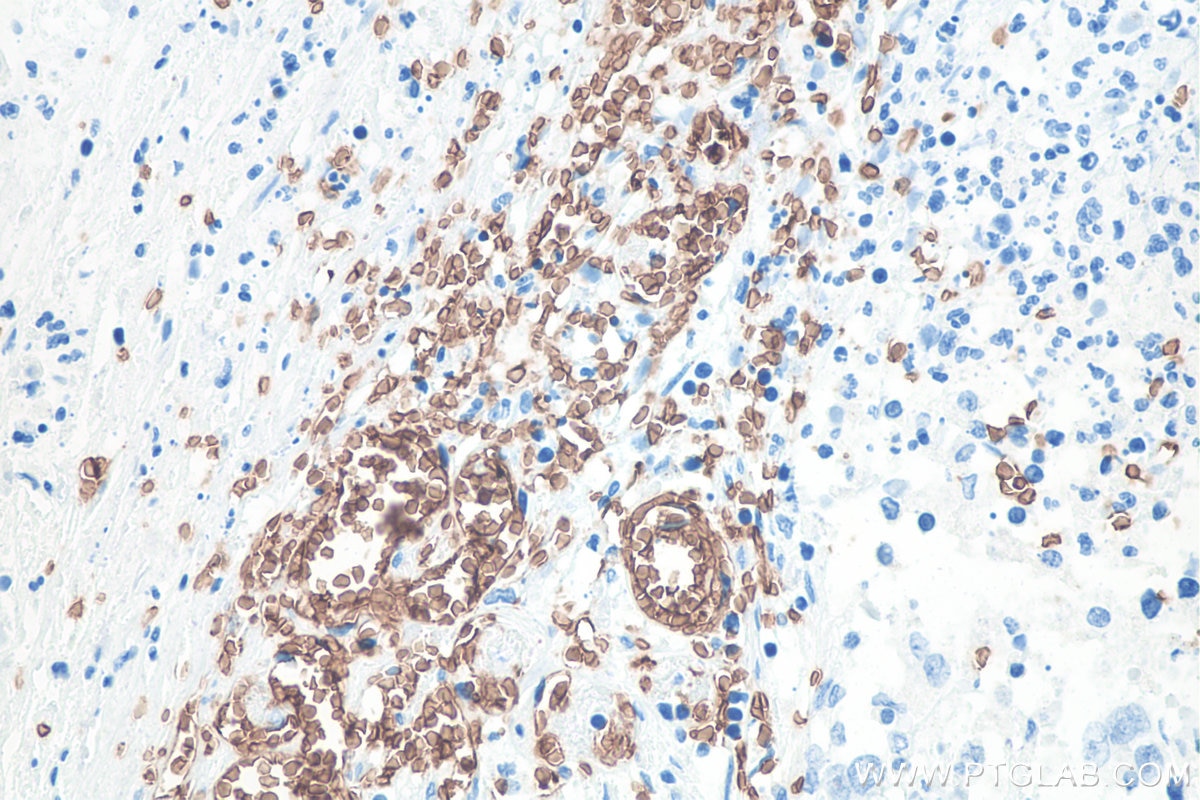 Immunohistochemistry (IHC) staining of human stomach cancer tissue using Glycophorin A/CD235a Monoclonal antibody (66778-1-Ig)