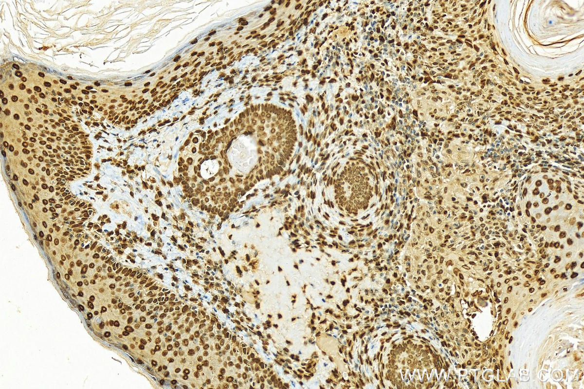 Immunohistochemistry (IHC) staining of human skin cancer tissue using Histone H1.0 Polyclonal antibody (17510-1-AP)