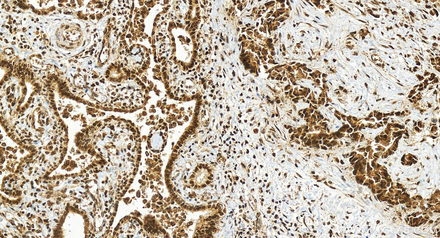 Immunohistochemistry (IHC) staining of human intrahepatic cholangiocarcinoma tissue using H2AFY Polyclonal antibody (26875-1-AP)