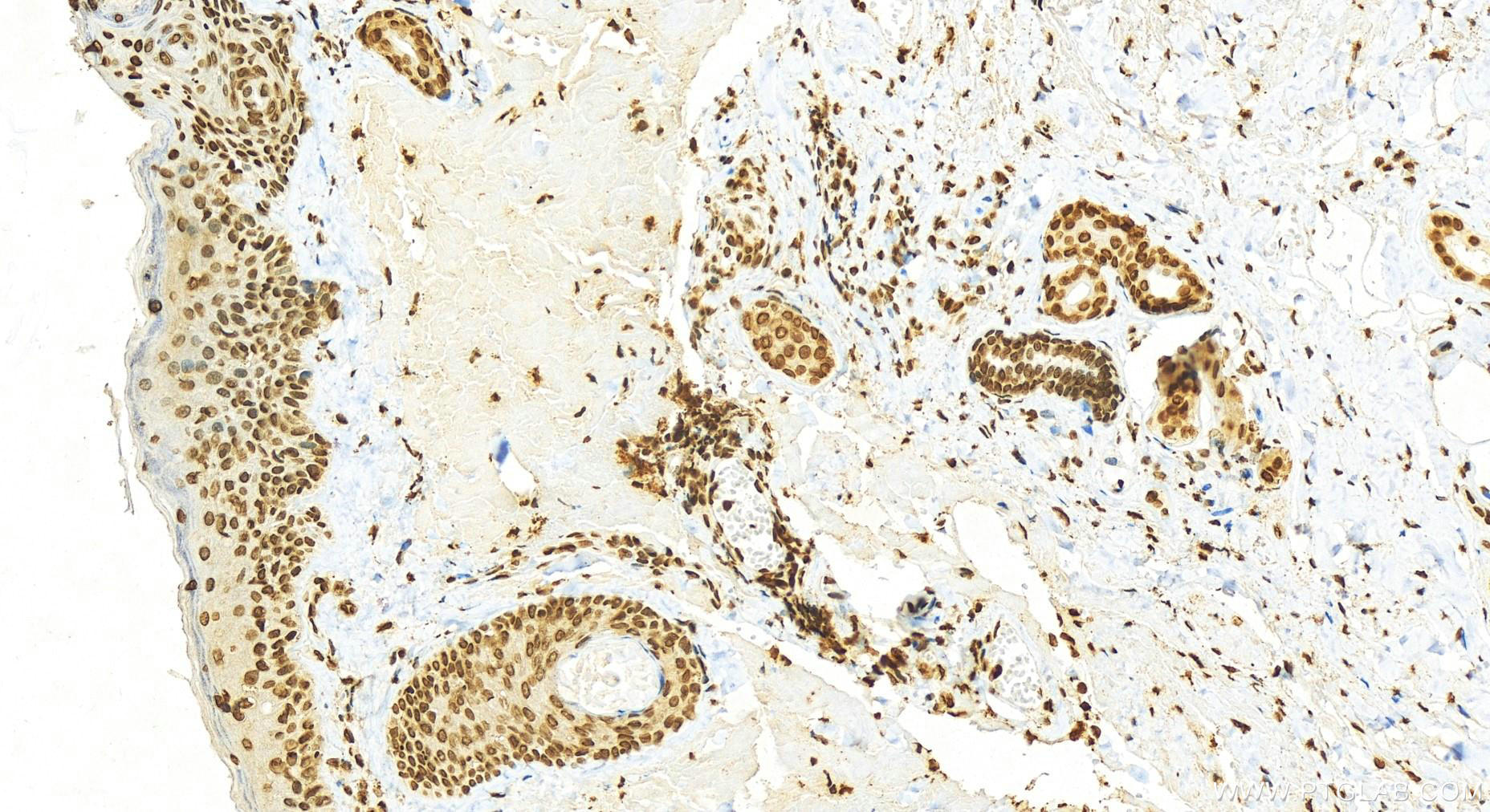 Immunohistochemistry (IHC) staining of human skin cancer tissue using Histone H2A.z Polyclonal antibody (16441-1-AP)