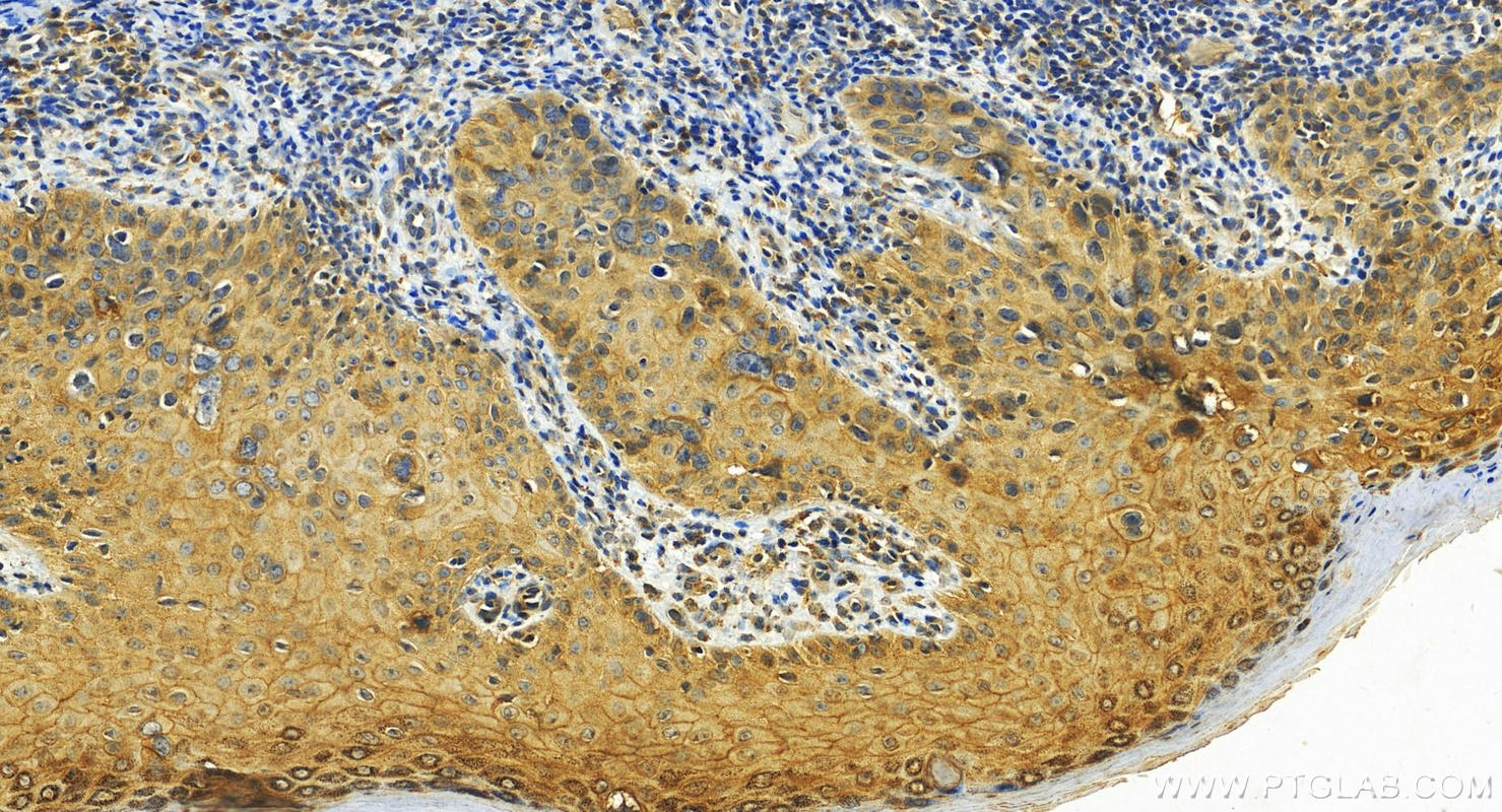 Immunohistochemistry (IHC) staining of human brown disease using HAI-1 Polyclonal antibody (27593-1-AP)