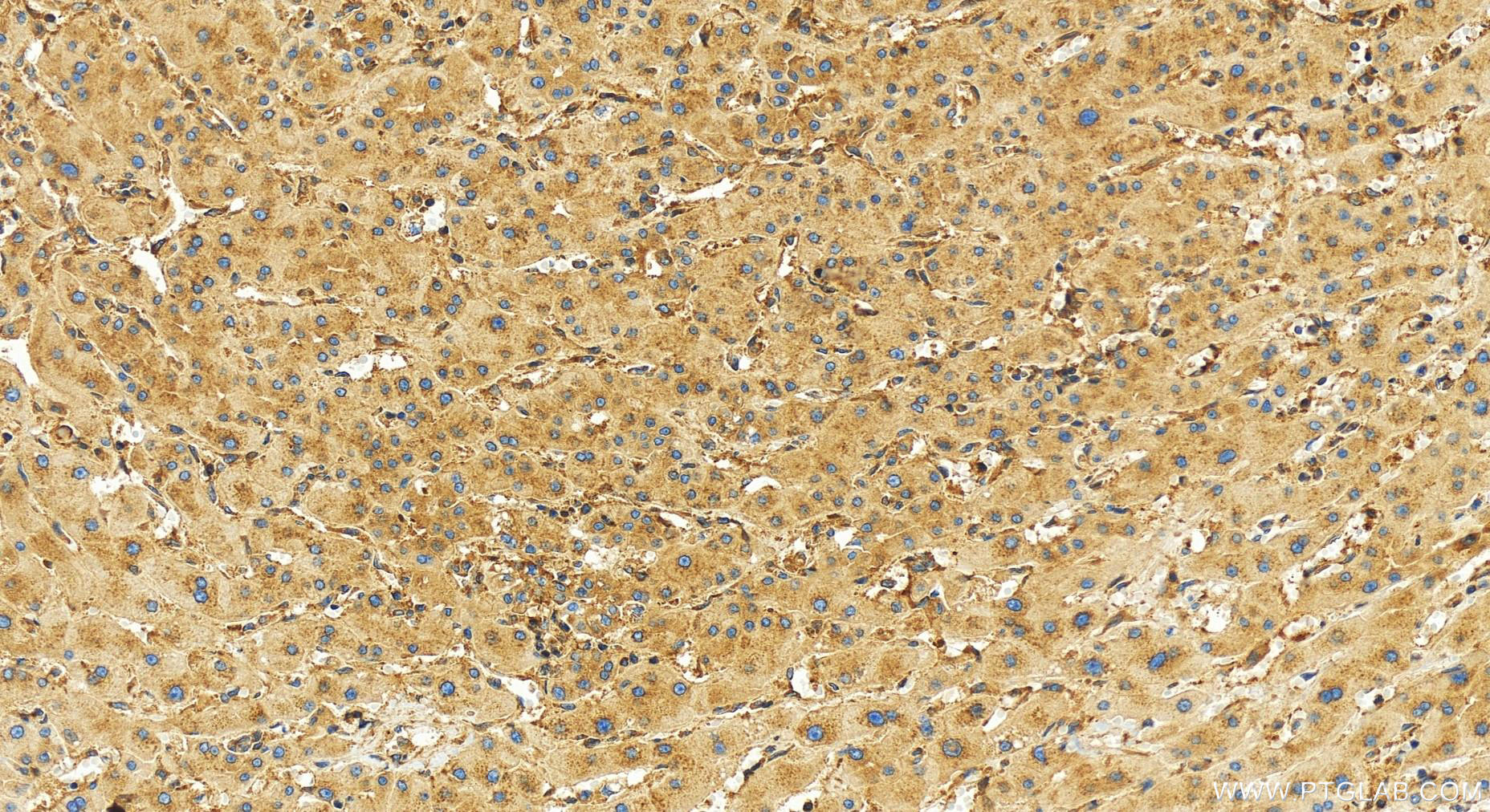 Immunohistochemistry (IHC) staining of human intrahepatic cholangiocarcinoma tissue using HARS Recombinant antibody (83497-1-RR)