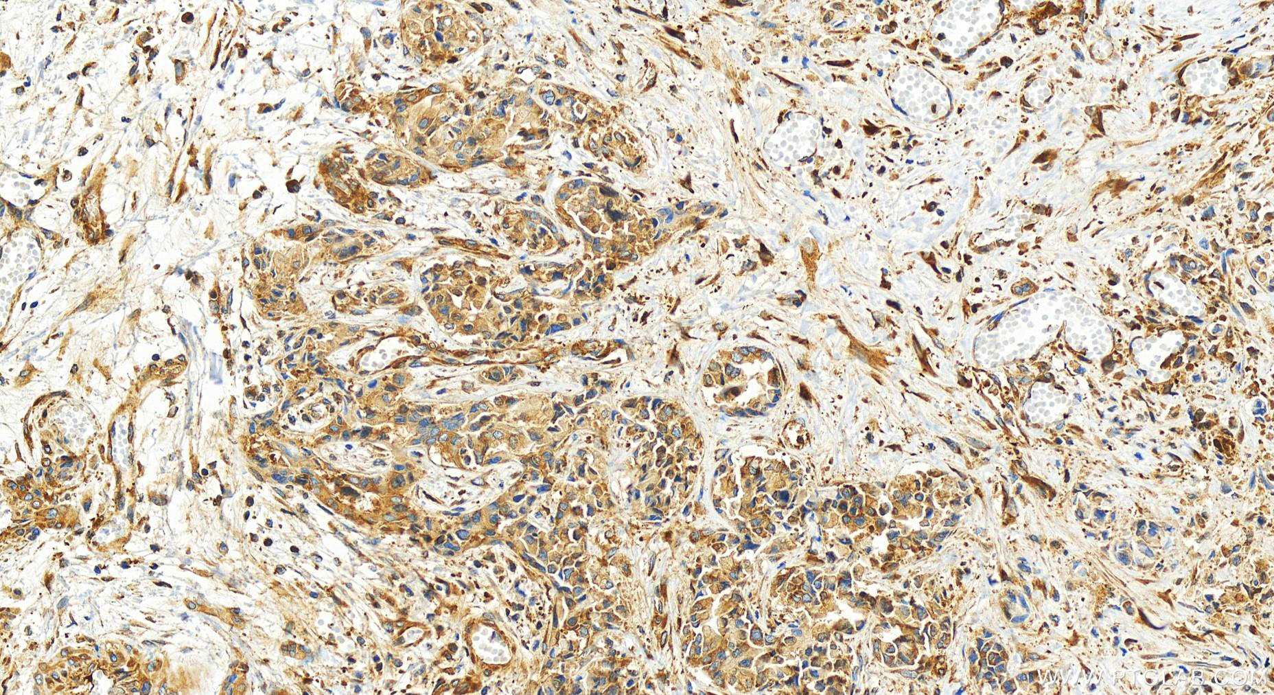 Immunohistochemistry (IHC) staining of human intrahepatic cholangiocarcinoma tissue using HARS Recombinant antibody (83497-1-RR)