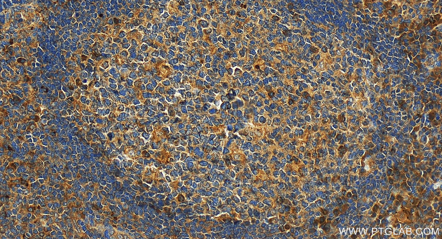 Immunohistochemistry (IHC) staining of human tonsillitis tissue using TIM3 Polyclonal antibody (11872-1-AP)