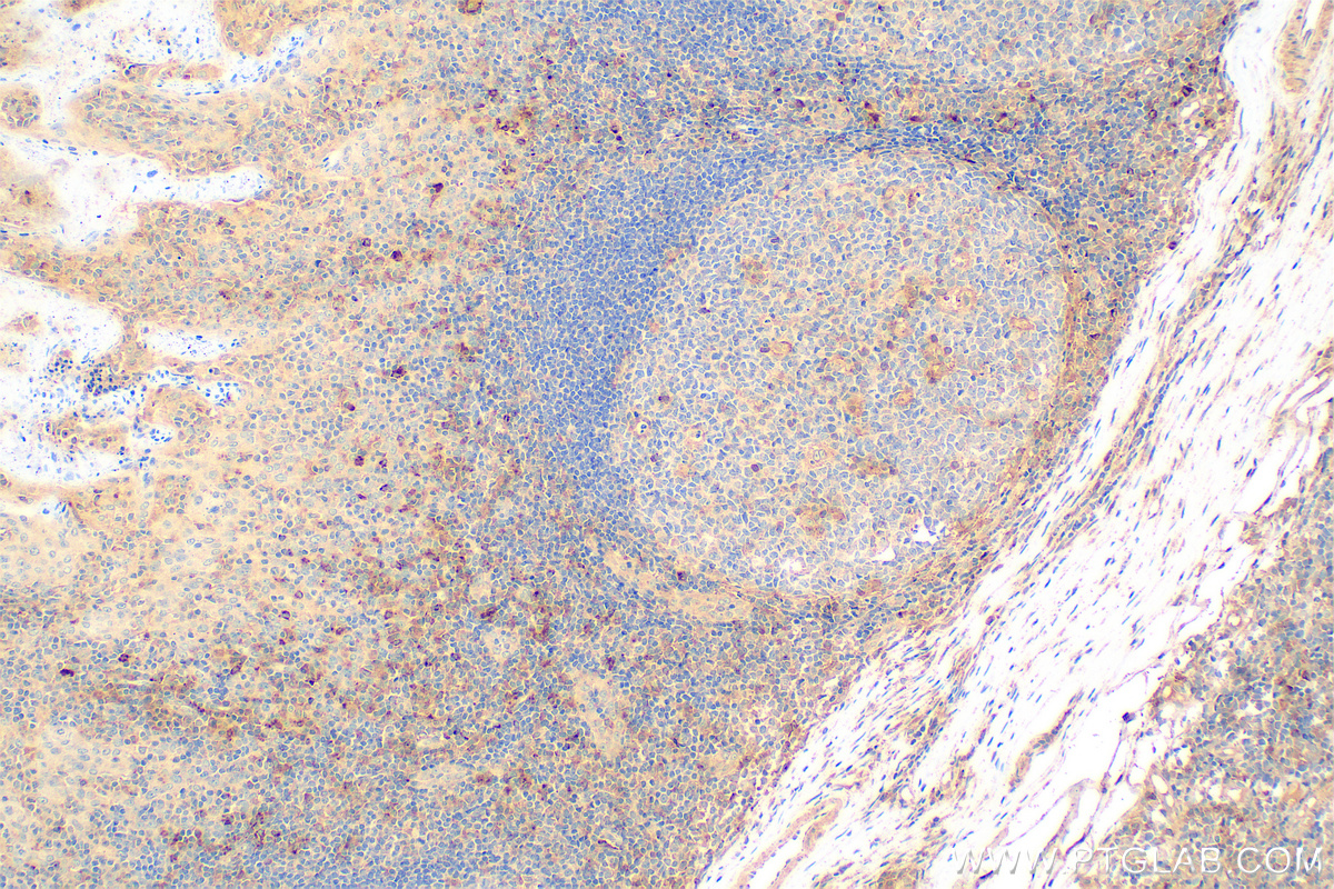 Immunohistochemistry (IHC) staining of human tonsillitis tissue using TIM3 Polyclonal antibody (11872-1-AP)