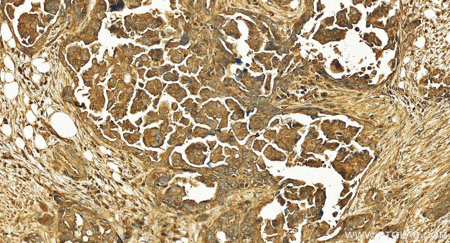 Immunohistochemistry (IHC) staining of human ovary cancer tissue using HDAC4-specific Polyclonal antibody (16165-1-AP)