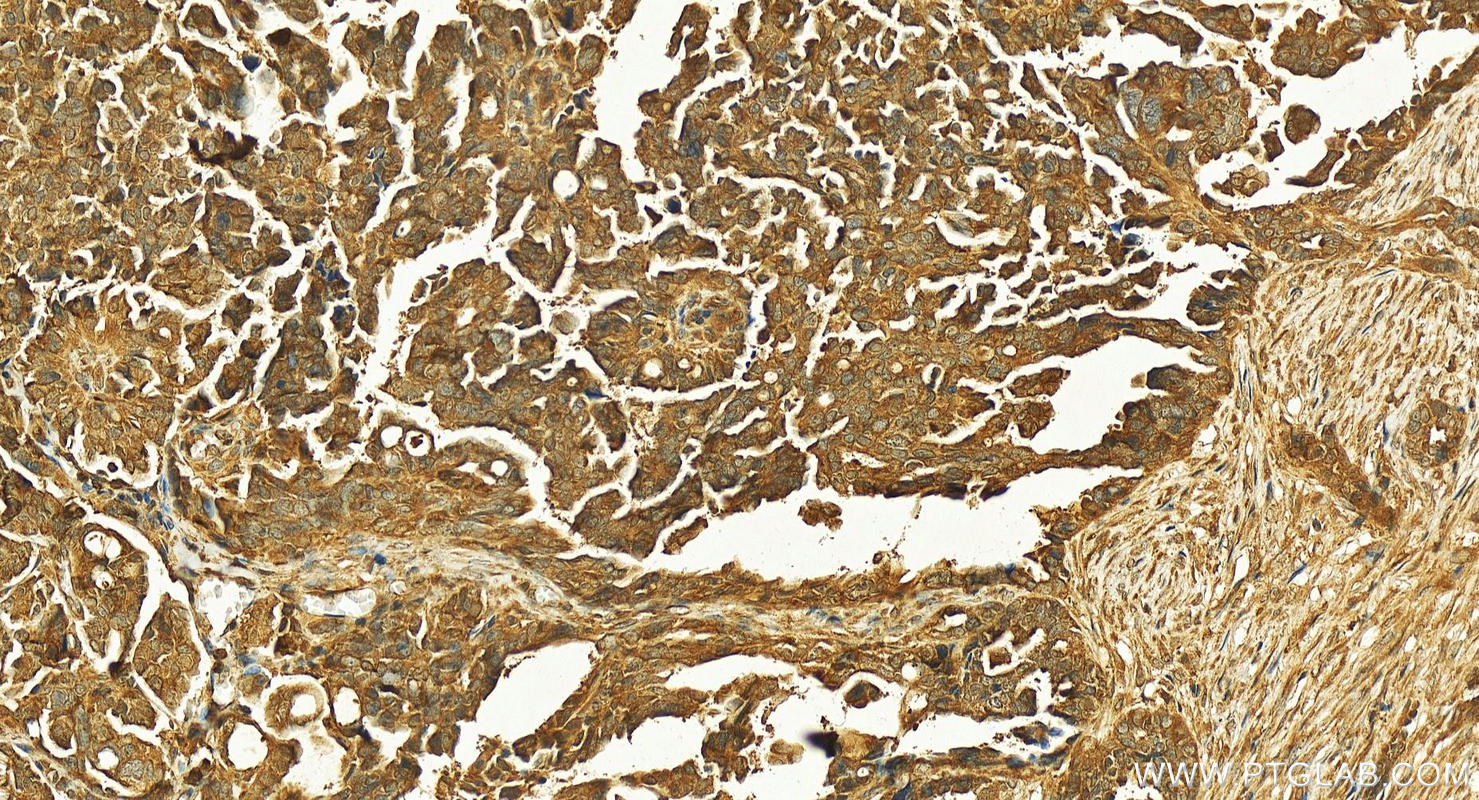 Immunohistochemistry (IHC) staining of human ovary cancer tissue using HDAC4-specific Polyclonal antibody (16165-1-AP)