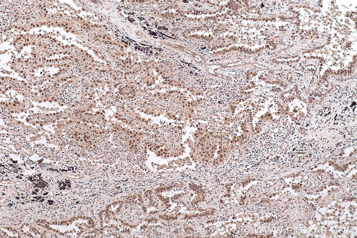 Immunohistochemistry (IHC) staining of human lung cancer tissue using HDAC8 Polyclonal antibody (17548-1-AP)