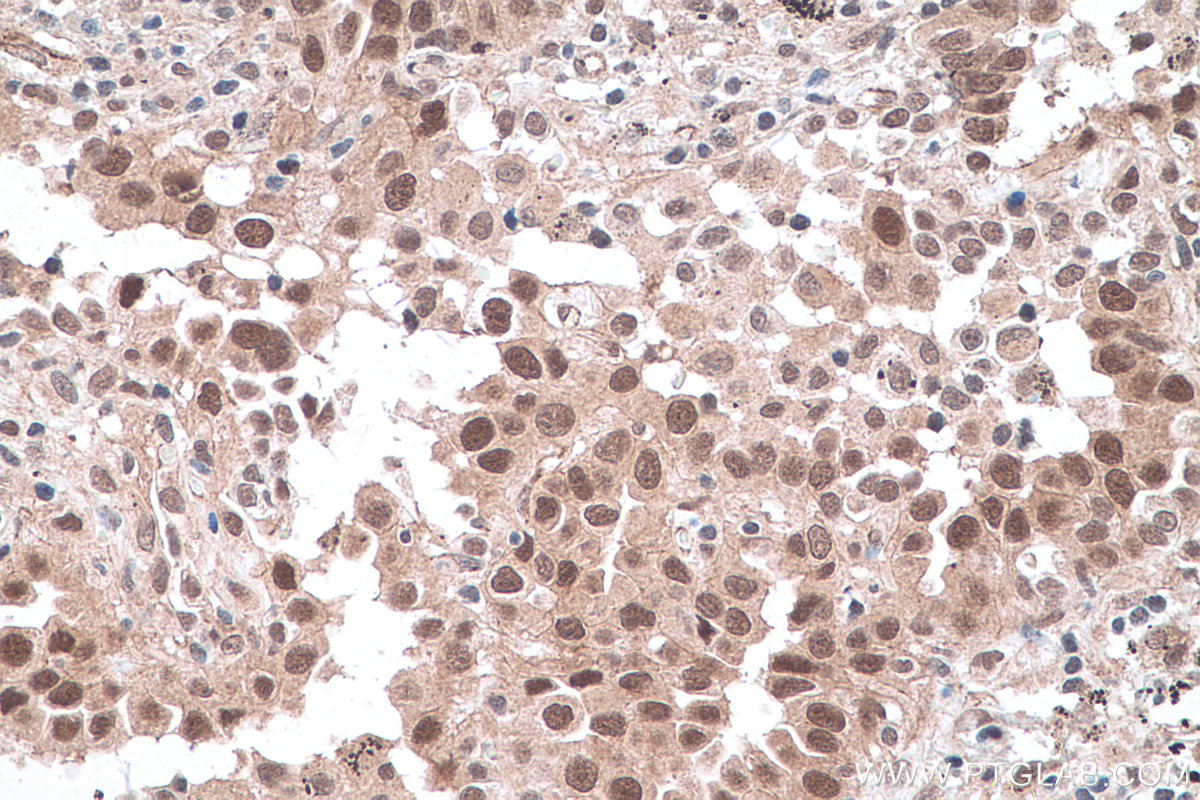 Immunohistochemistry (IHC) staining of human lung cancer tissue using HDAC8 Polyclonal antibody (17548-1-AP)