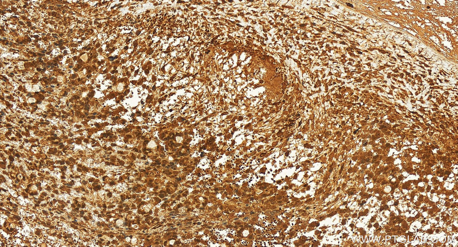 Immunohistochemistry (IHC) staining of human ovary cancer tissue using HEATR3 Polyclonal antibody (27335-1-AP)