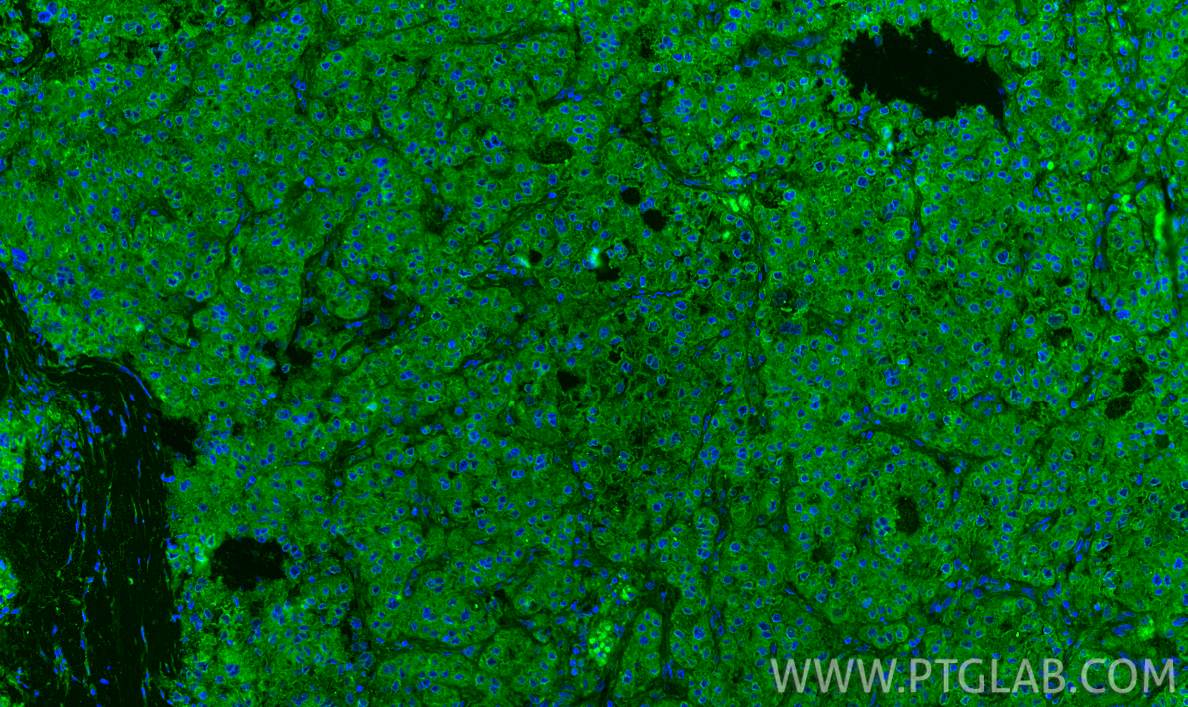 Immunofluorescence (IF) / fluorescent staining of human liver cancer tissue using HGF Polyclonal antibody (26881-1-AP)