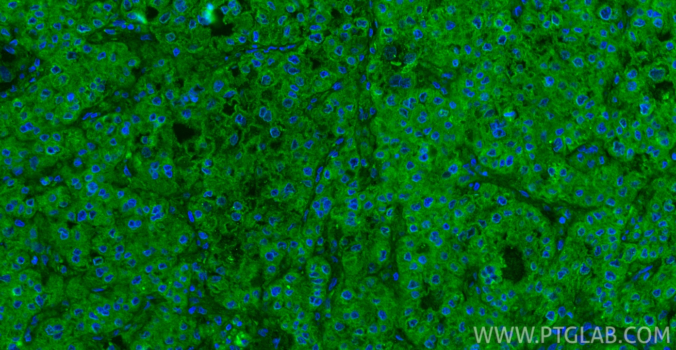 Immunofluorescence (IF) / fluorescent staining of human liver cancer tissue using HGF Polyclonal antibody (26881-1-AP)