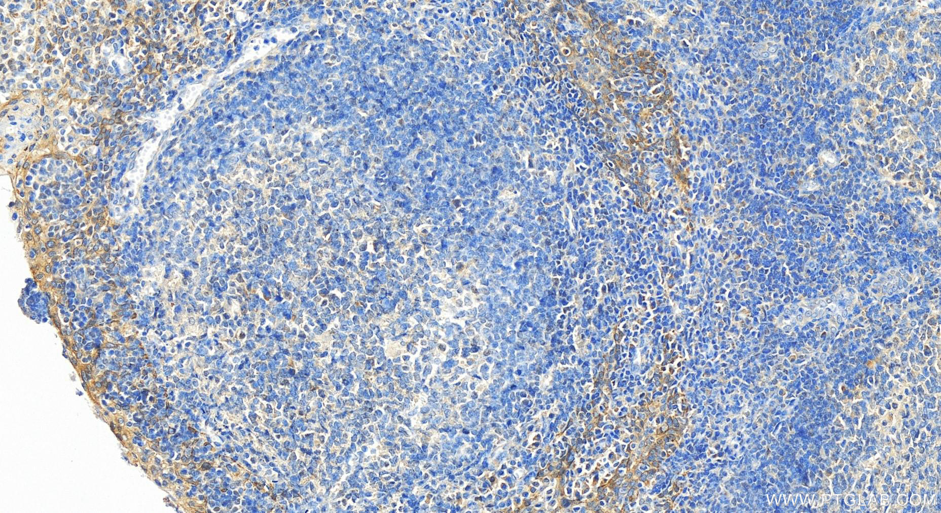 Immunohistochemistry (IHC) staining of human tonsillitis tissue using HGF Polyclonal antibody (26881-1-AP)