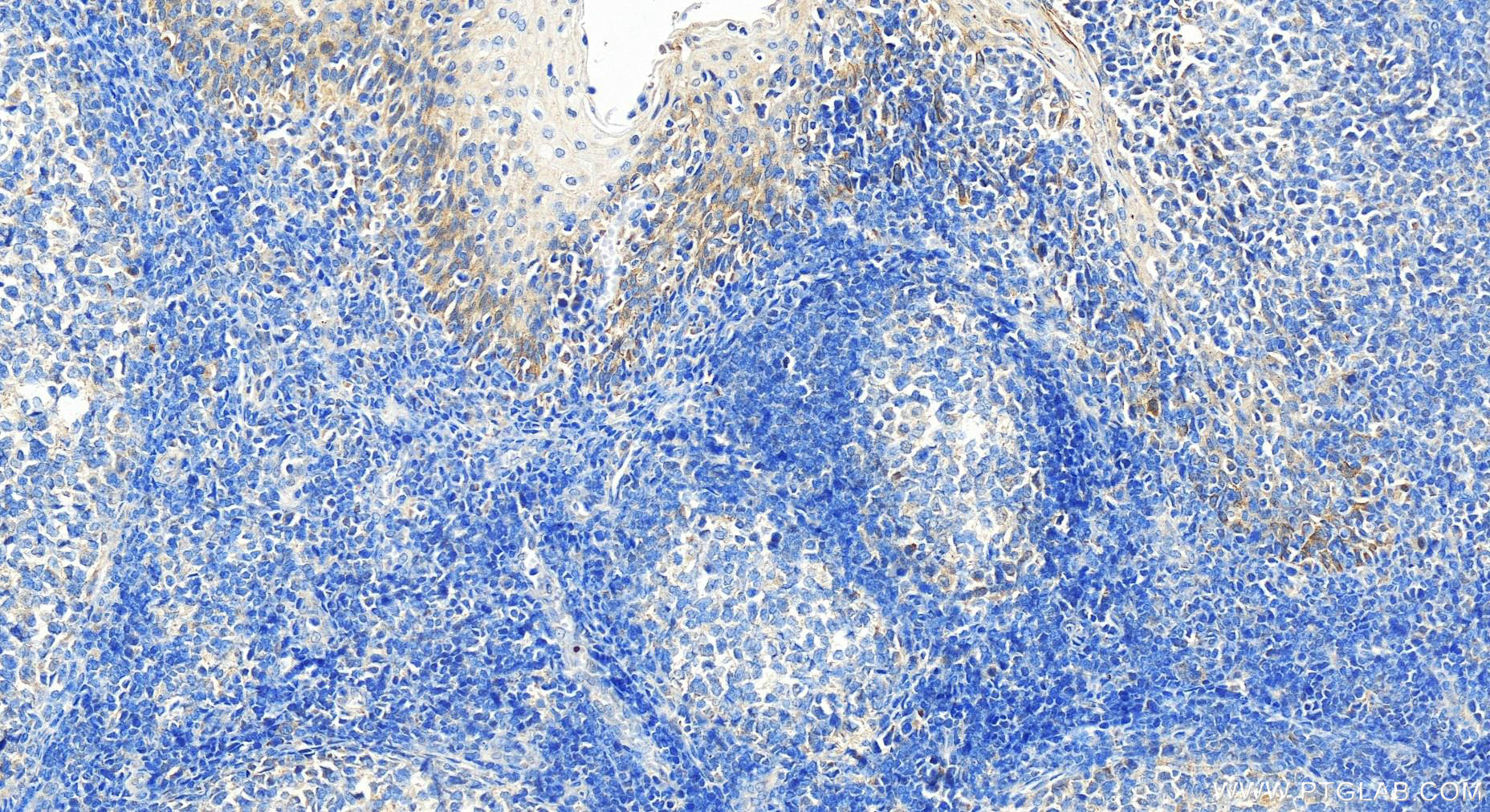 Immunohistochemistry (IHC) staining of human tonsillitis tissue using HGF Polyclonal antibody (26881-1-AP)