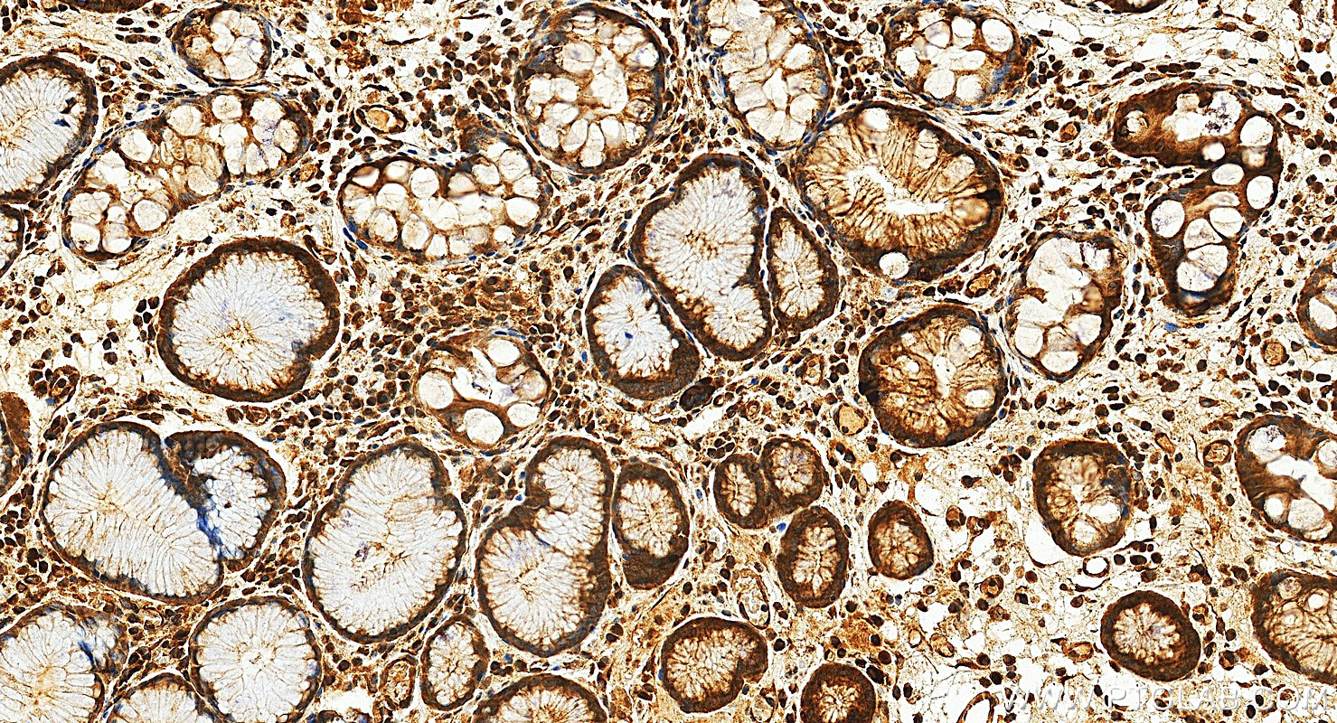 Immunohistochemistry (IHC) staining of human stomach cancer tissue using HIF-1 alpha Polyclonal antibody (20960-1-AP)