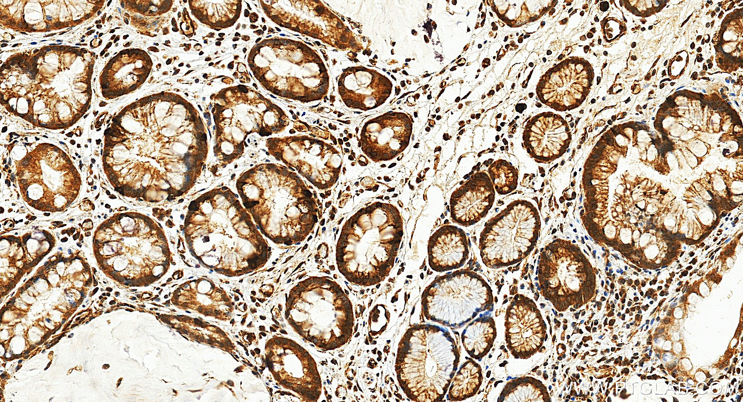 Immunohistochemistry (IHC) staining of human stomach cancer tissue using HIF-1 alpha Polyclonal antibody (20960-1-AP)