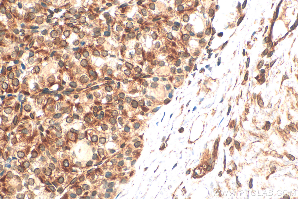 Immunohistochemistry (IHC) staining of human thyroid cancer tissue using HIF-1 alpha Polyclonal antibody (20960-1-AP)