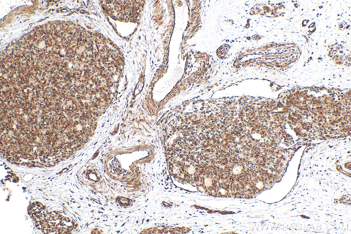 Immunohistochemistry (IHC) staining of human thyroid cancer tissue using HIF-1 alpha Polyclonal antibody (20960-1-AP)