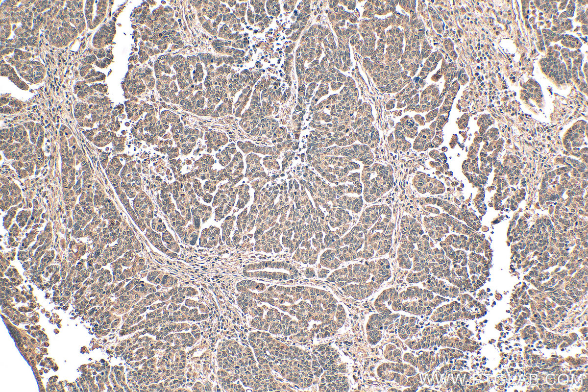 Immunohistochemistry (IHC) staining of human ovary tumor tissue using HIF-1 alpha Monoclonal antibody (66730-1-Ig)