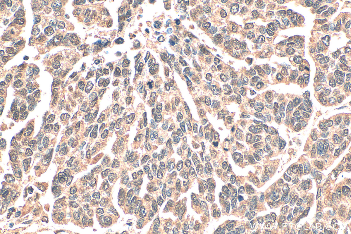 Immunohistochemistry (IHC) staining of human ovary tumor tissue using HIF-1 alpha Monoclonal antibody (66730-1-Ig)