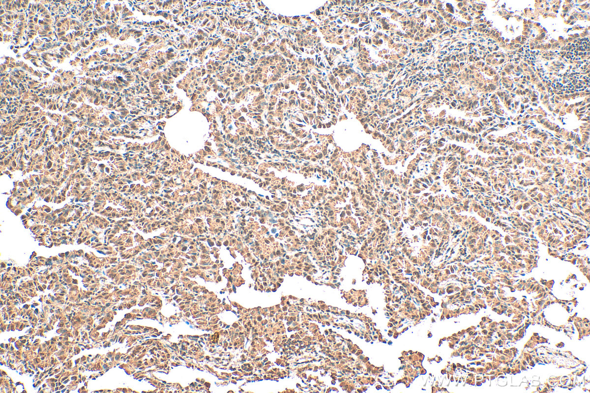 Immunohistochemistry (IHC) staining of human lung cancer tissue using HIF-1 alpha Monoclonal antibody (66730-1-Ig)