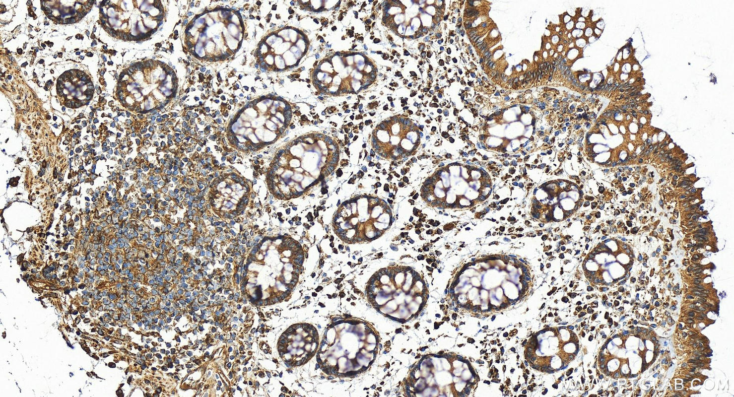 Immunohistochemistry (IHC) staining of human colon tissue using HIF-1 alpha Recombinant antibody (80933-1-RR)