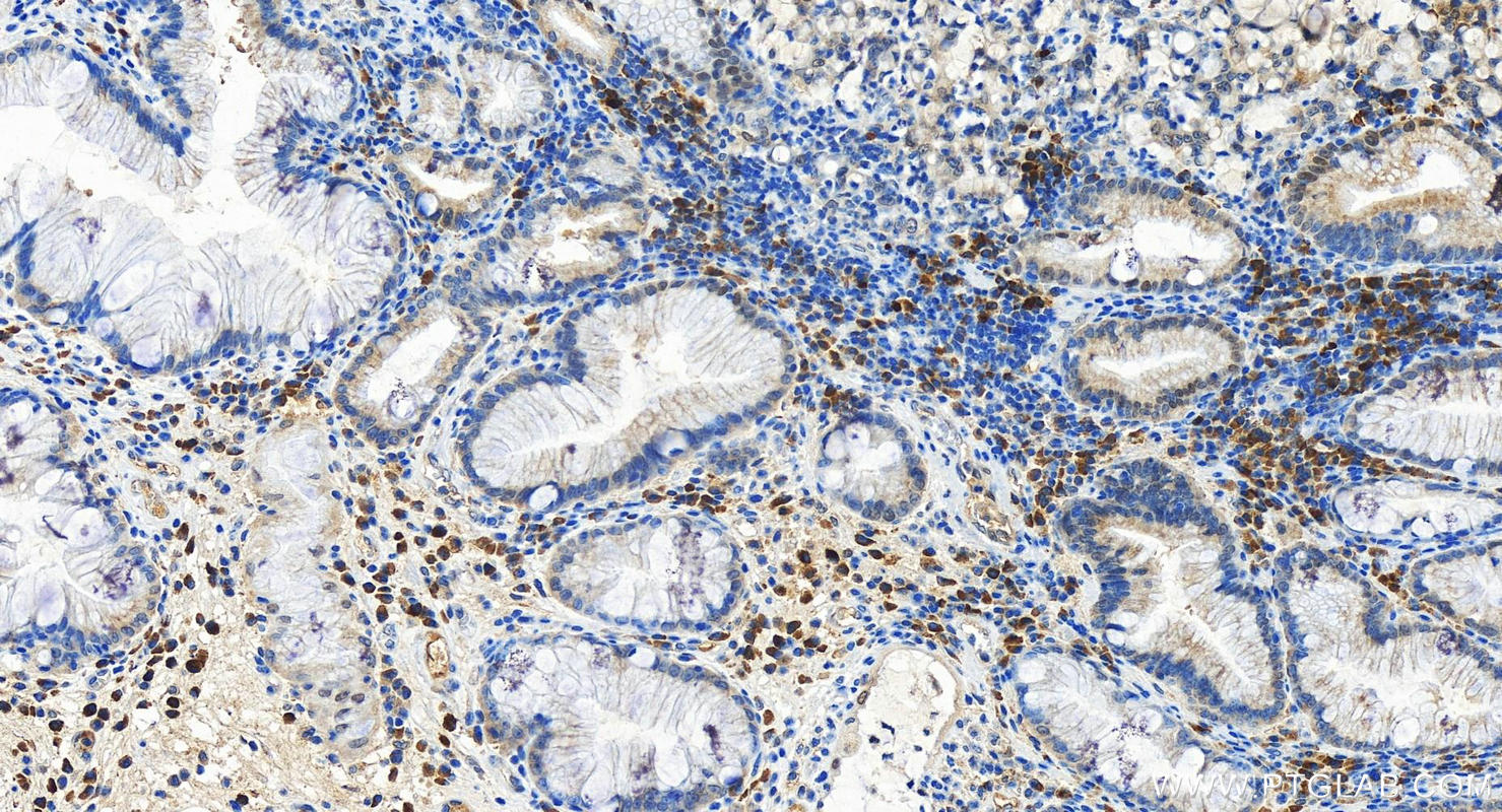 Immunohistochemistry (IHC) staining of human stomach cancer tissue using HIF-1 alpha Recombinant antibody (80933-1-RR)