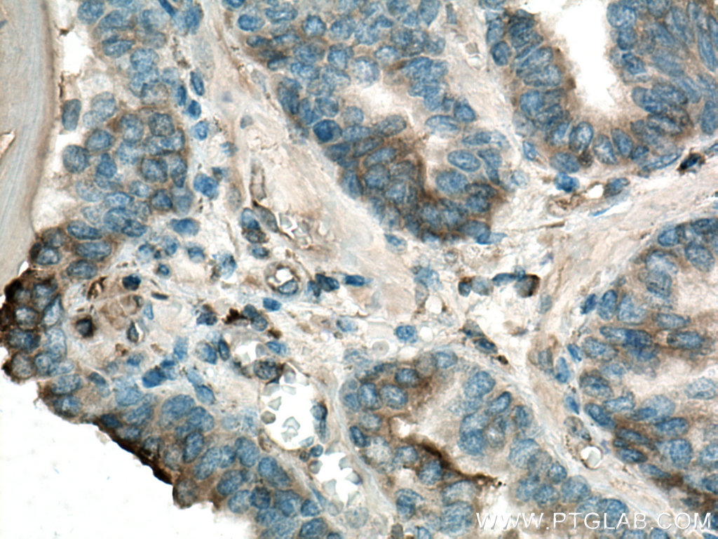 Immunohistochemistry (IHC) staining of human prostate cancer tissue using HIP1 Polyclonal antibody (22231-1-AP)