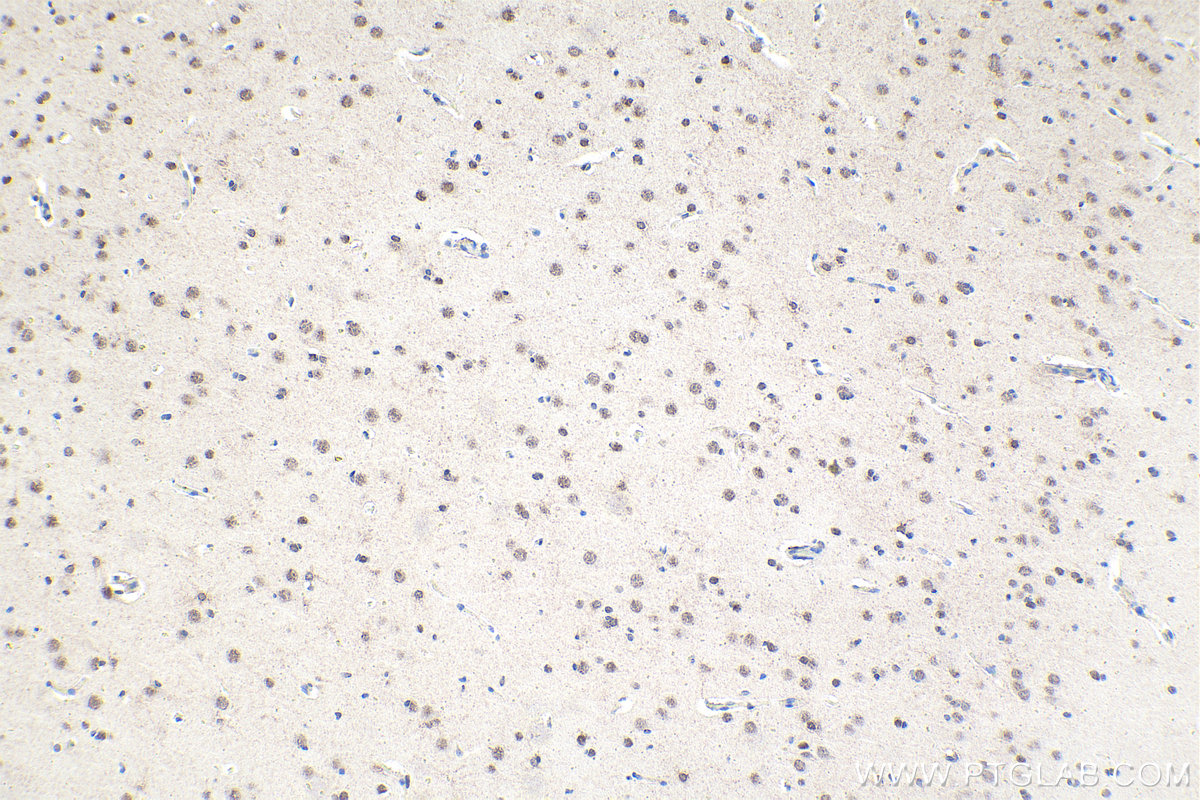 Immunohistochemistry (IHC) staining of human gliomas tissue using HIPK2 Polyclonal antibody (55408-1-AP)