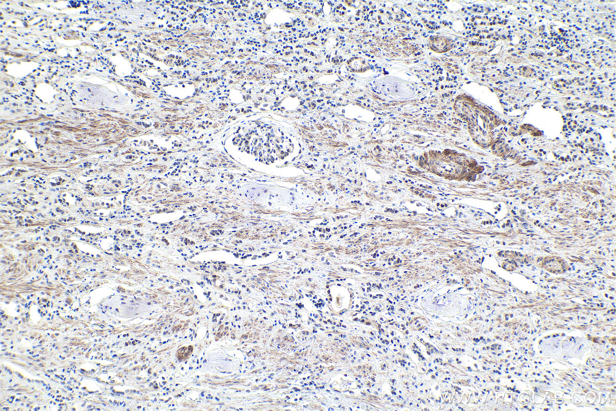 Immunohistochemistry (IHC) staining of human renal cell carcinoma tissue using HIPK2 Polyclonal antibody (55408-1-AP)