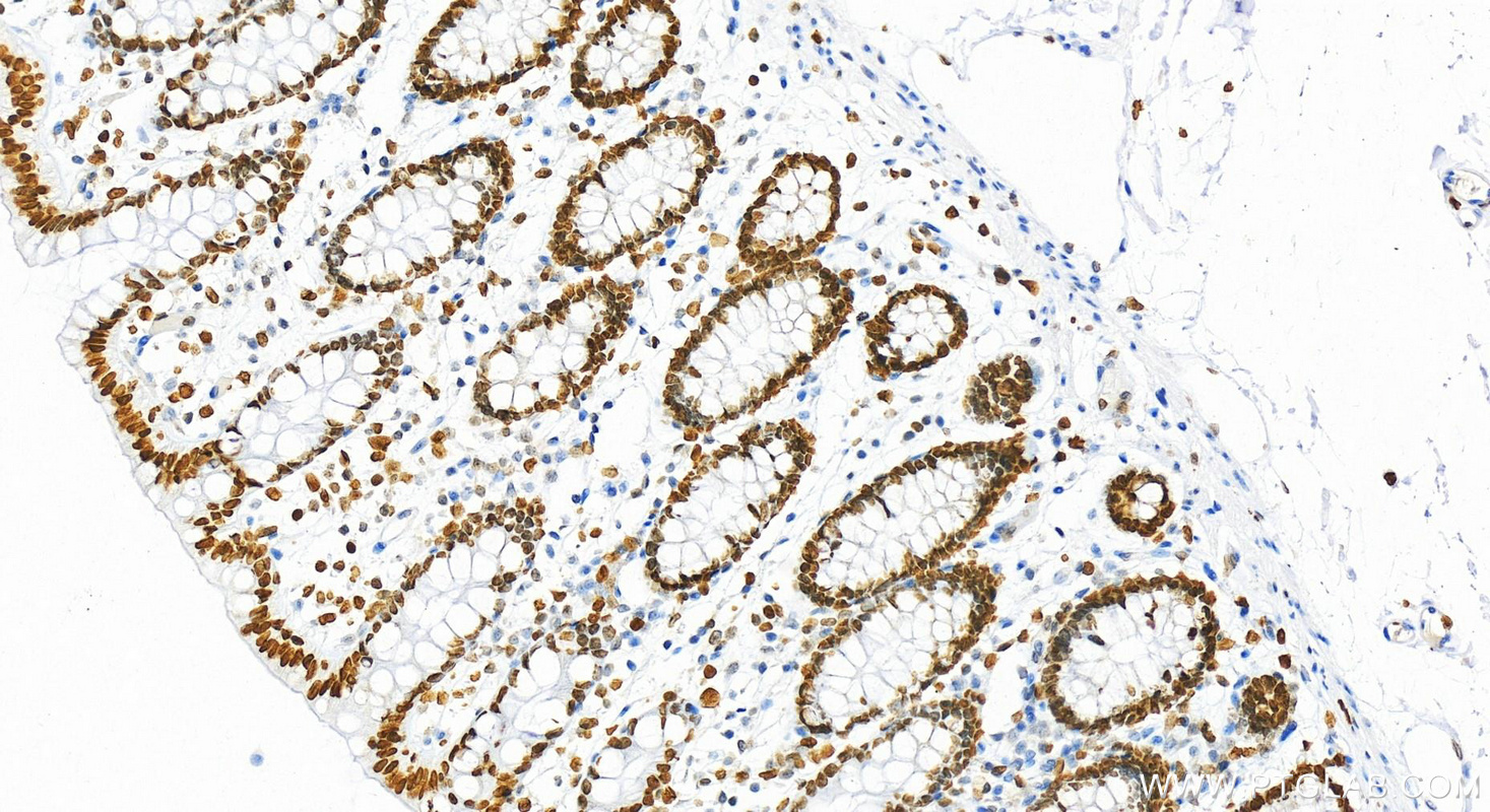 Immunohistochemistry (IHC) staining of human colon tissue using HIST1H1B Polyclonal antibody (18093-1-AP)