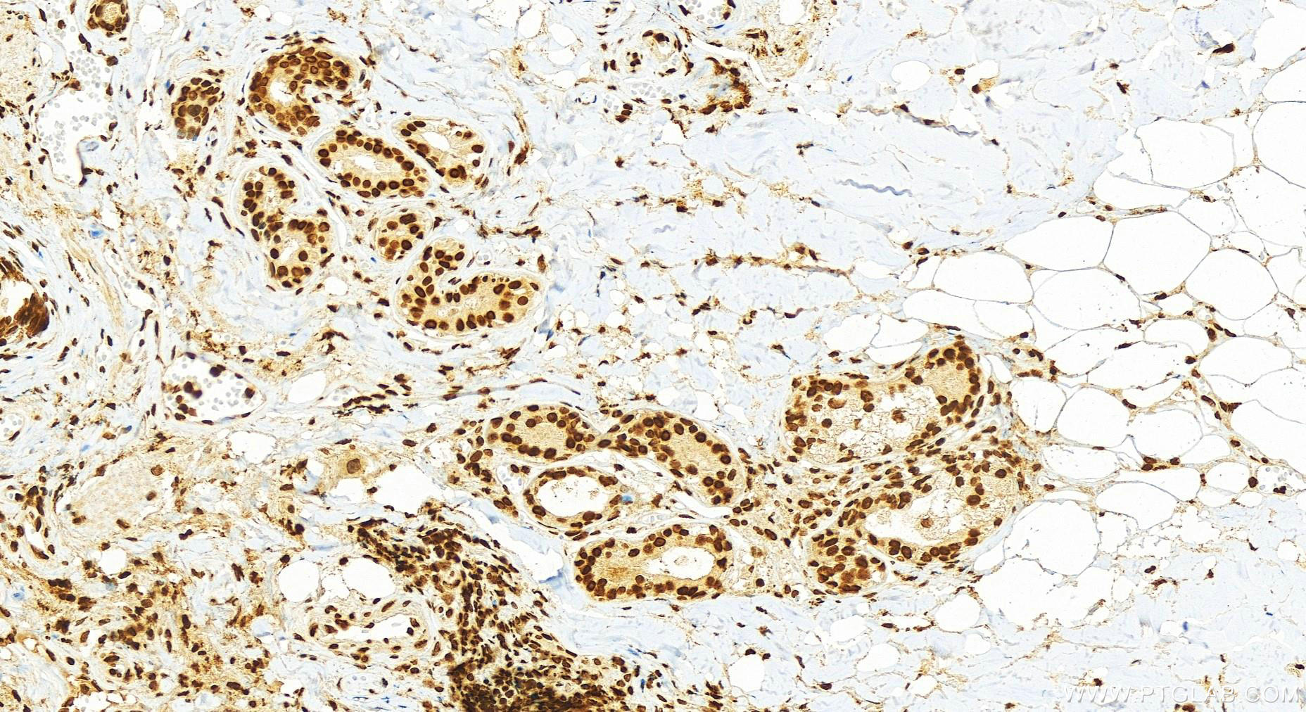 Immunohistochemistry (IHC) staining of human skin cancer tissue using HIST1H2AC Polyclonal antibody (15953-1-AP)