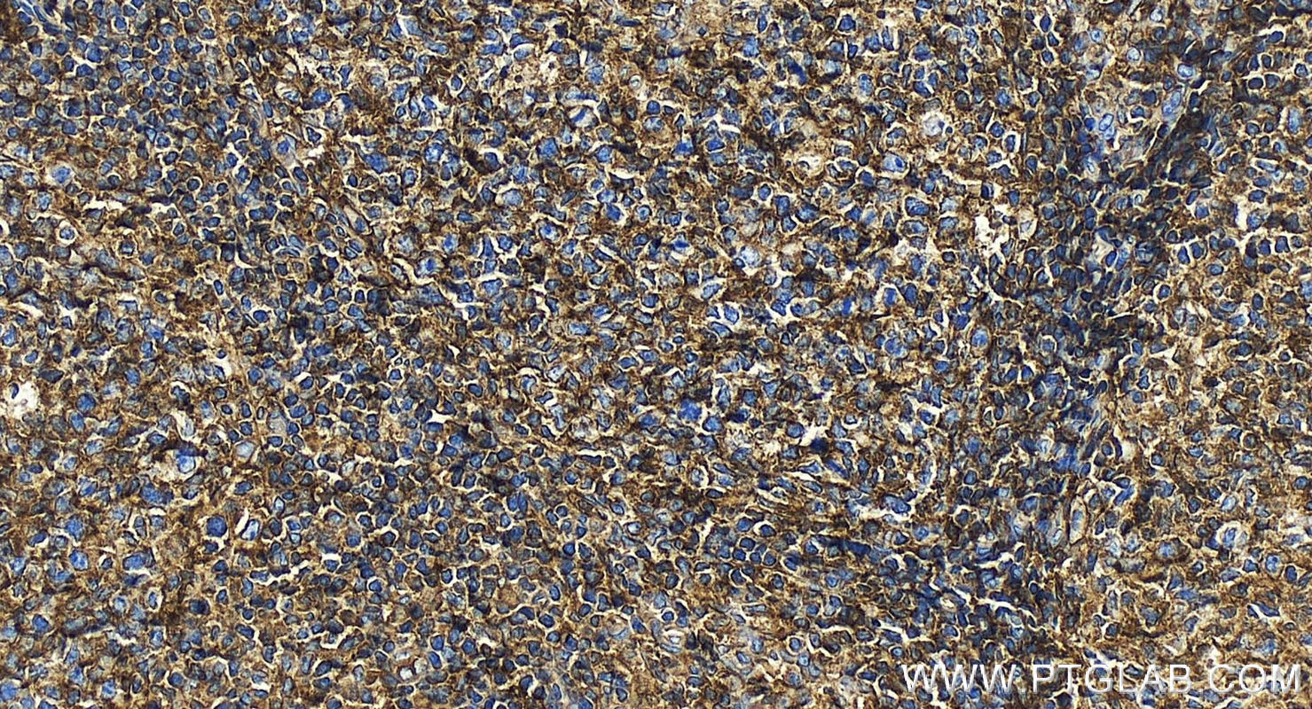 Immunohistochemistry (IHC) staining of human tonsillitis tissue using HLA class I ABC Polyclonal antibody (15240-1-AP)