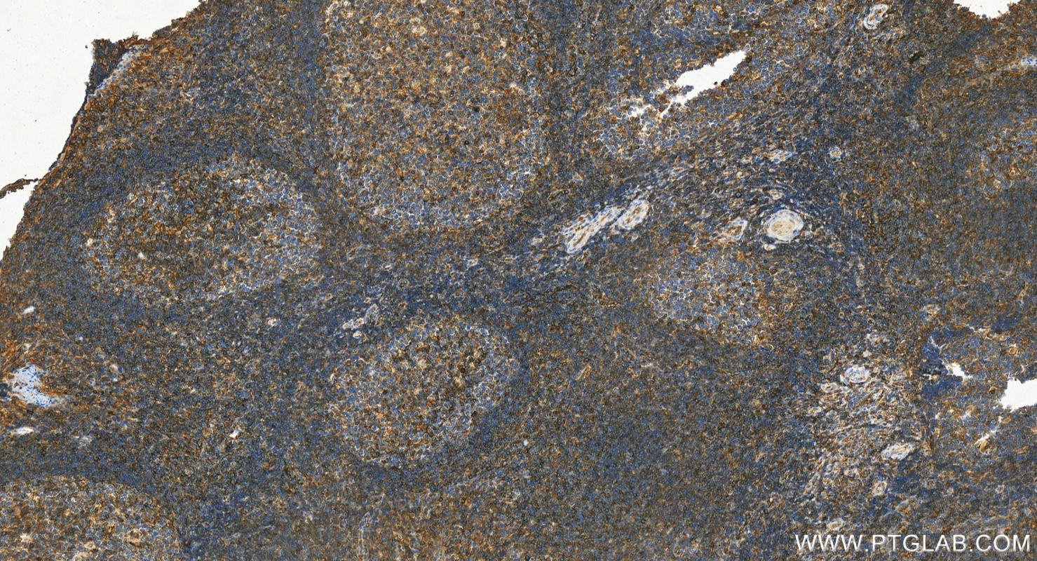 Immunohistochemistry (IHC) staining of human tonsillitis tissue using HLA-A Polyclonal antibody (55383-1-AP)