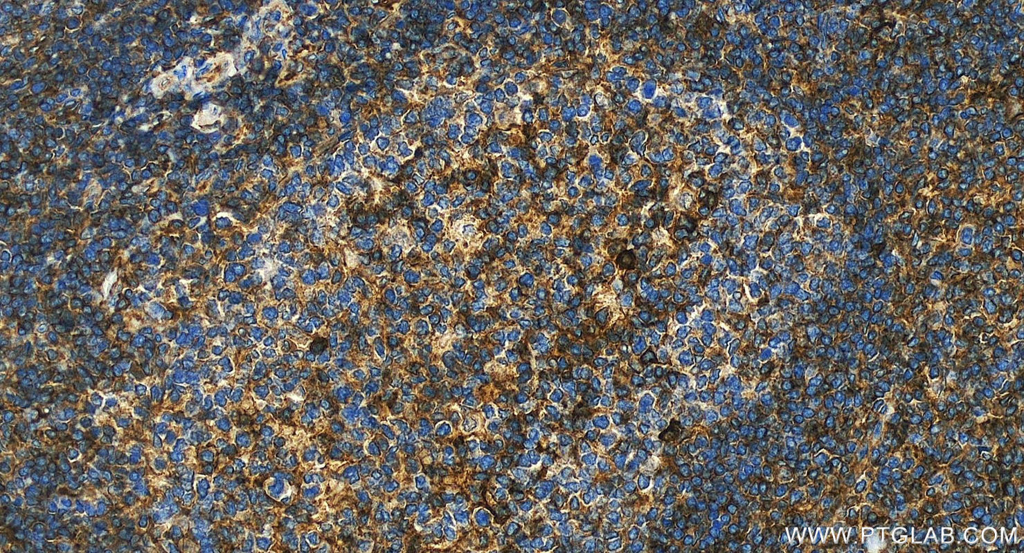 Immunohistochemistry (IHC) staining of human tonsillitis tissue using HLA-A Polyclonal antibody (55383-1-AP)