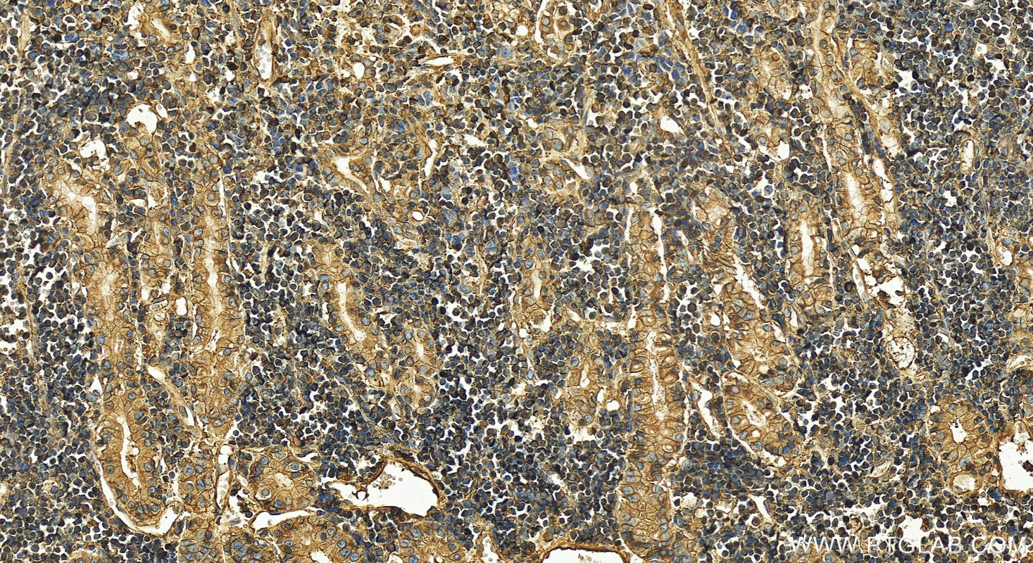 Immunohistochemistry (IHC) staining of human stomach cancer tissue using HLA class I (HLA-B) Polyclonal antibody (17260-1-AP)