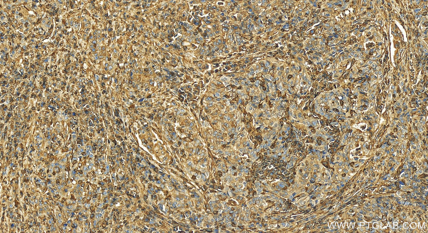 Immunohistochemistry (IHC) staining of human stomach cancer tissue using HLA class I (HLA-B) Polyclonal antibody (17260-1-AP)