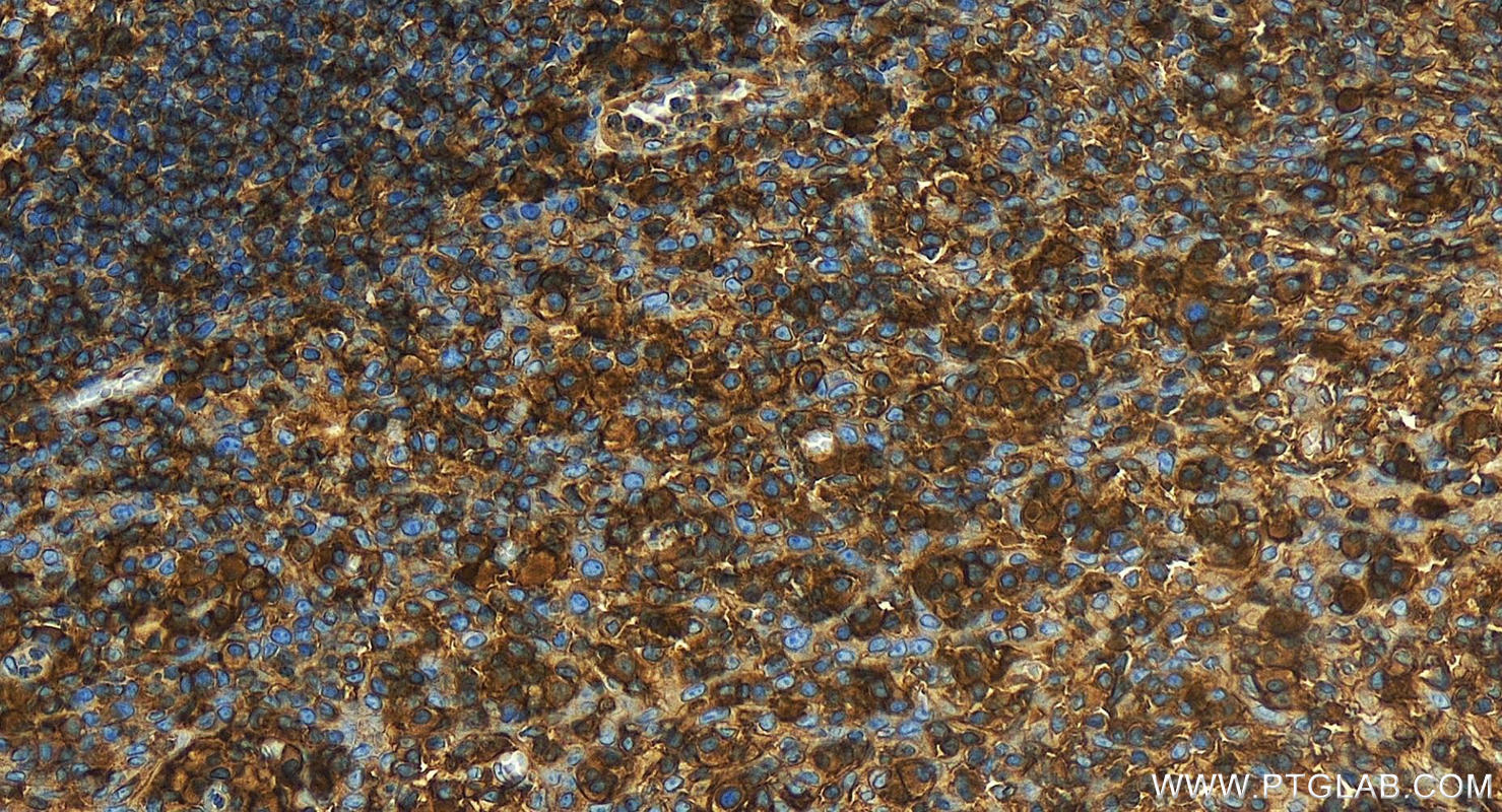 Immunohistochemistry (IHC) staining of human tonsillitis tissue using HLA class I (HLA-C) Polyclonal antibody (15777-1-AP)