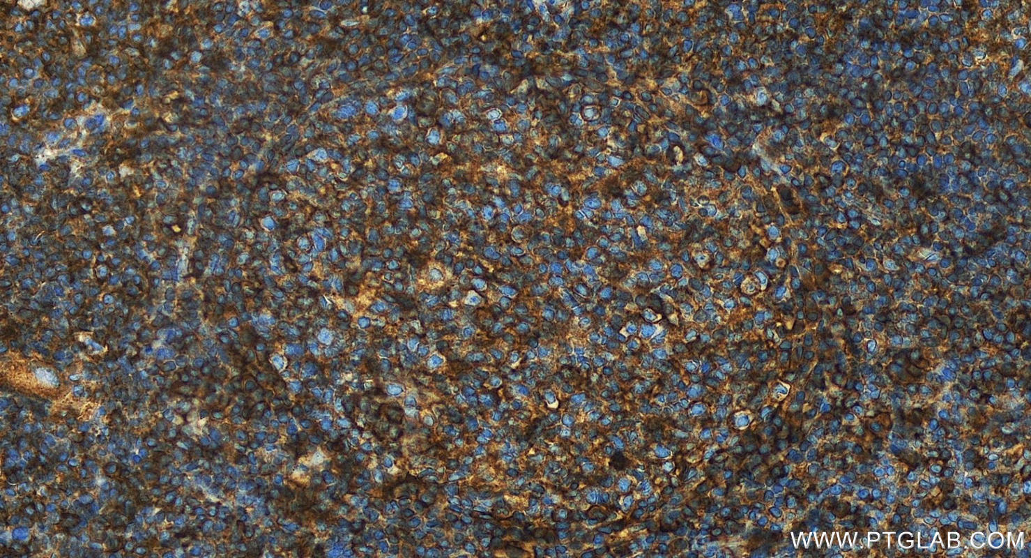 Immunohistochemistry (IHC) staining of human tonsillitis tissue using HLA class I (HLA-C) Polyclonal antibody (15777-1-AP)