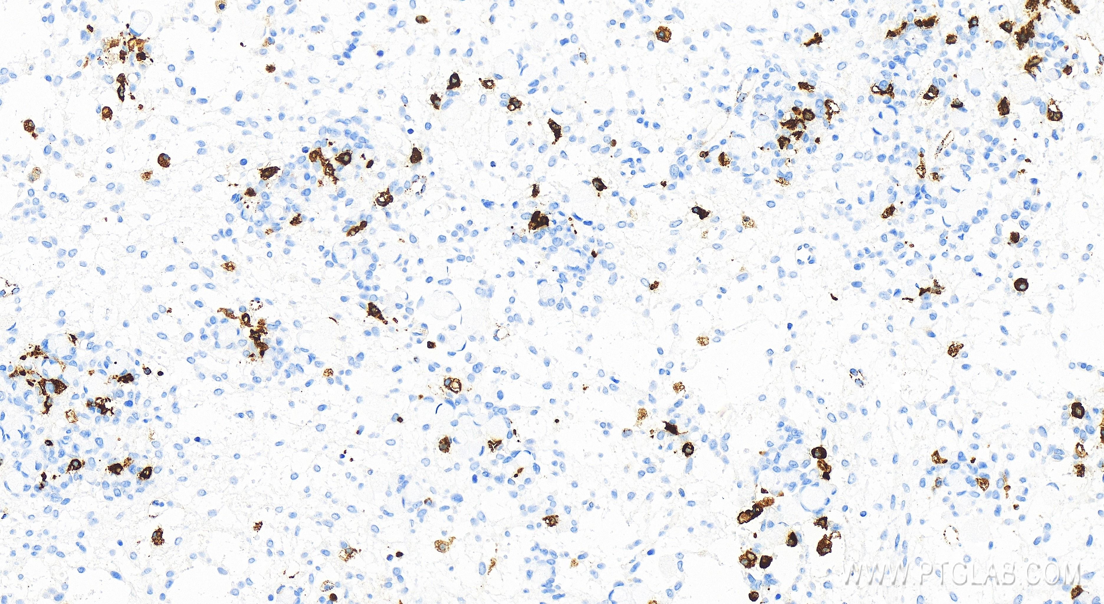 Immunohistochemistry (IHC) staining of human ovary cancer tissue using HLA-DMB Recombinant antibody (82922-1-RR)