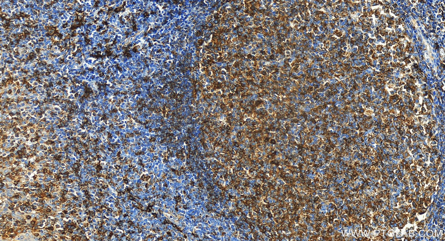 Immunohistochemistry (IHC) staining of human tonsillitis tissue using HLA-DQA1 Polyclonal antibody (16918-1-AP)