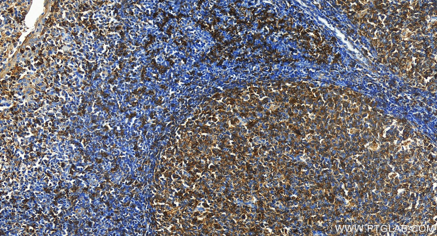 Immunohistochemistry (IHC) staining of human tonsillitis tissue using HLA-DQA1 Polyclonal antibody (16918-1-AP)