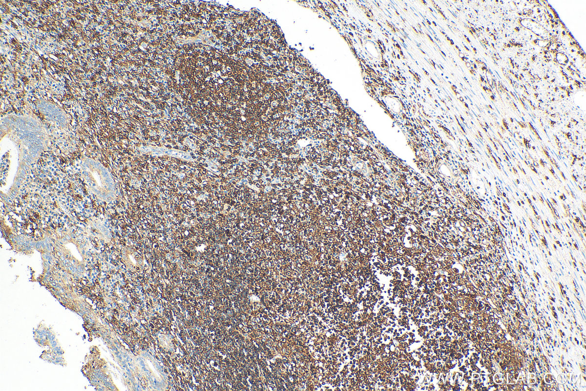 Immunohistochemistry (IHC) staining of human appendicitis tissue using HLA-DRA Polyclonal antibody (17221-1-AP)