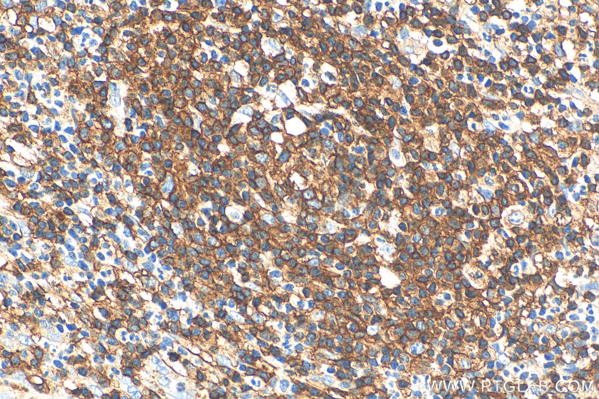 Immunohistochemistry (IHC) staining of human appendicitis tissue using HLA-DRA Polyclonal antibody (17221-1-AP)